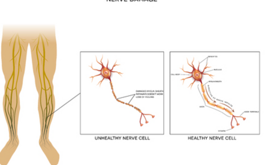 What Is Neuropathy? A Beginner’s Guide to Nerve Pain & Damage